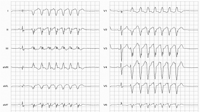 Non-sustained Ventricular Tachycardia 12 Lead EKG